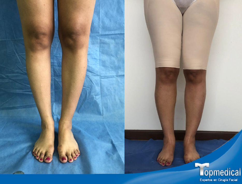 Liposucción Corporal | Topmedical
